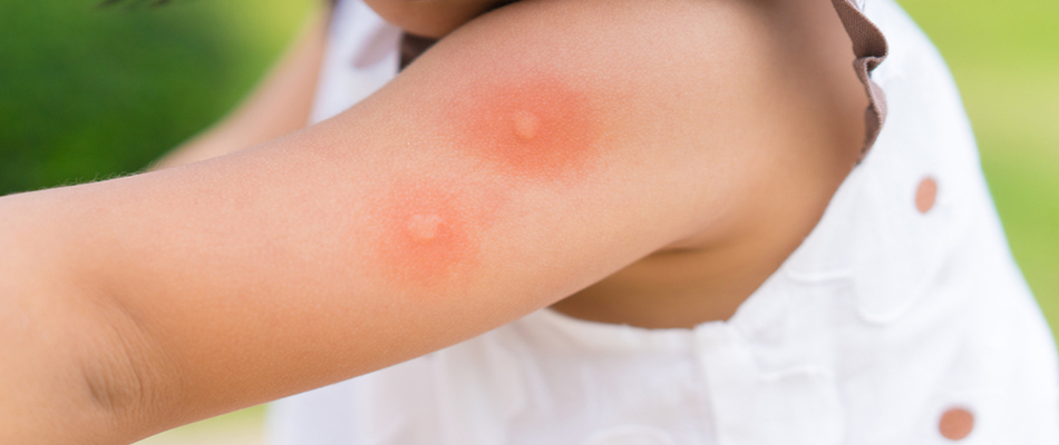 Bug bites shown on a child in Plano, TX.