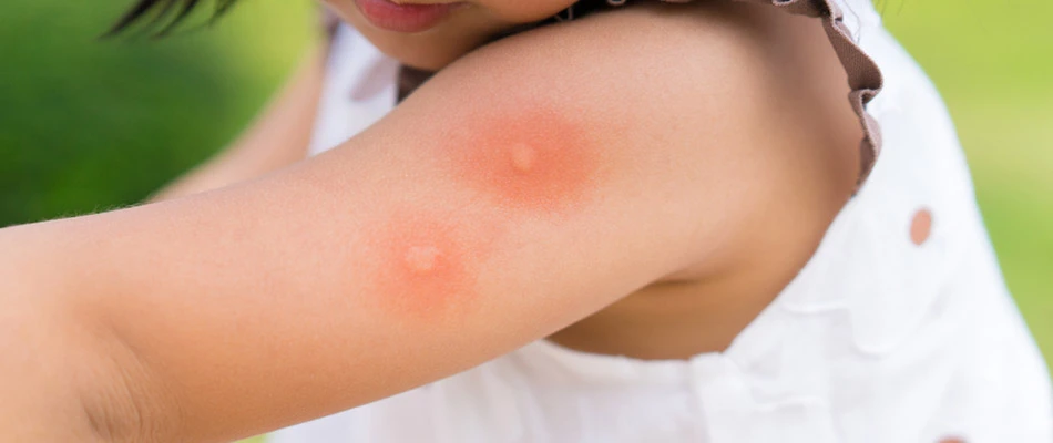 A child with two mosquito bites at a home in Allen, TX.